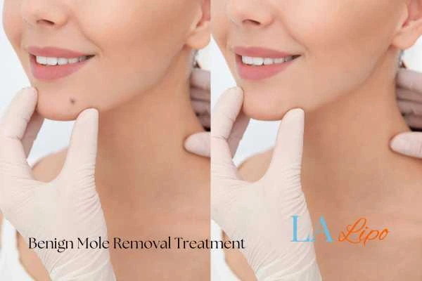 woman's before and after mole removal Handsworth results