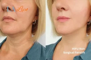 hi-fu for wrinkles Handsworth before and after results