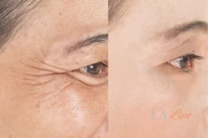 Before and after results of woman - HI-fu wrinkles reduction treatment Handsworth