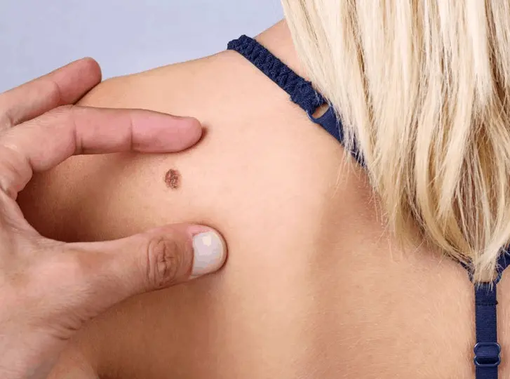 woman having mole removal Handsworth consultation before treatment.