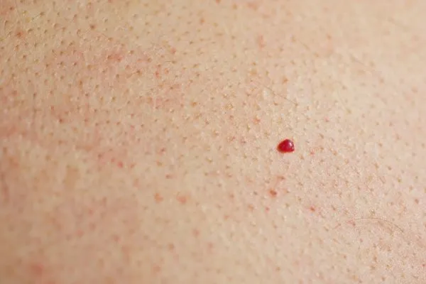 close up of a cherry angioma Handsworth