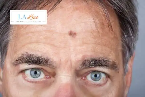 Solar Lentigo Removal Handsworth image of man with mark on his forehead