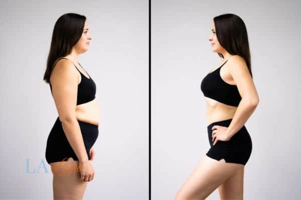 Picture of womans before and after using LA-EMS body sculpting to improve her core strength Handsworth