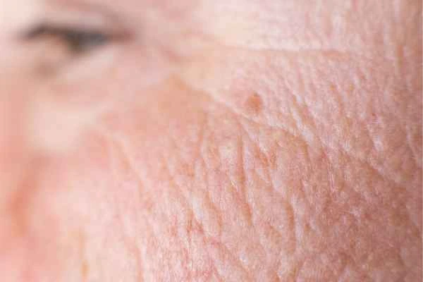 close up picture of a woman's face showing an age spot Handsworth