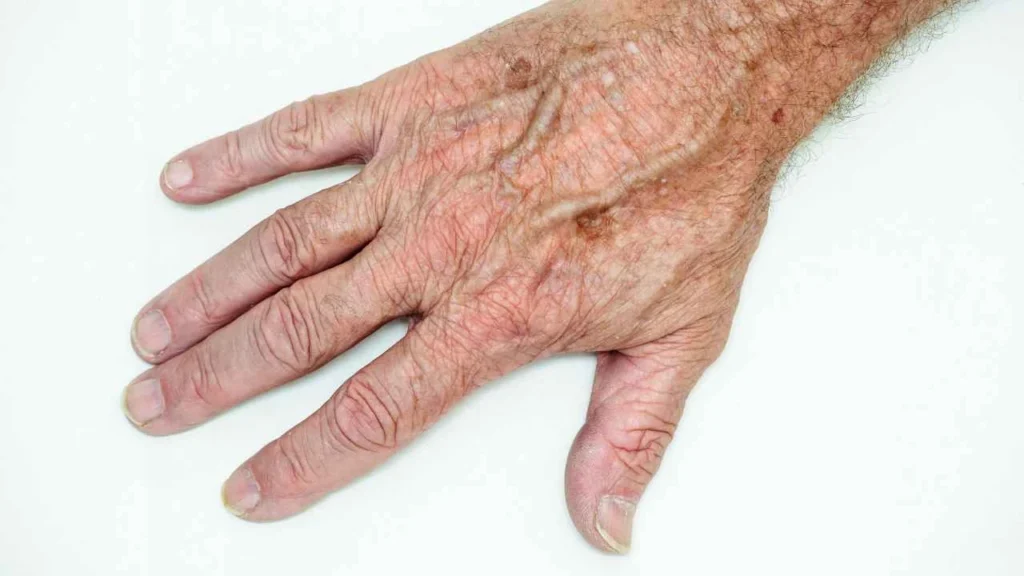 Male hand showing age spot Handsworth