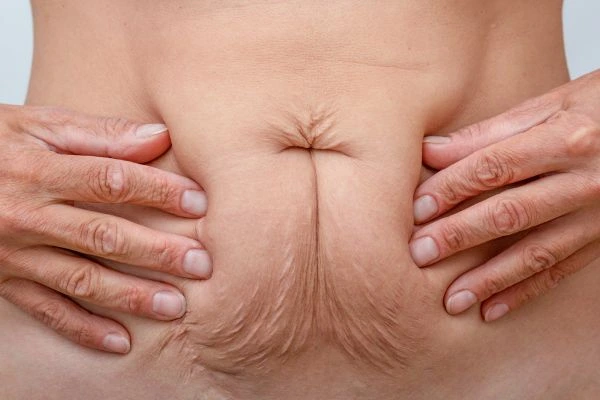 Should I Combine Diastasis Recti Treatment with Body Contouring for Better Results Handsworth?
