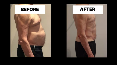 What Symptoms Can Diastasis Recti Cause in Men? Weak Core, Back Pain and Poor Posture Handsworth